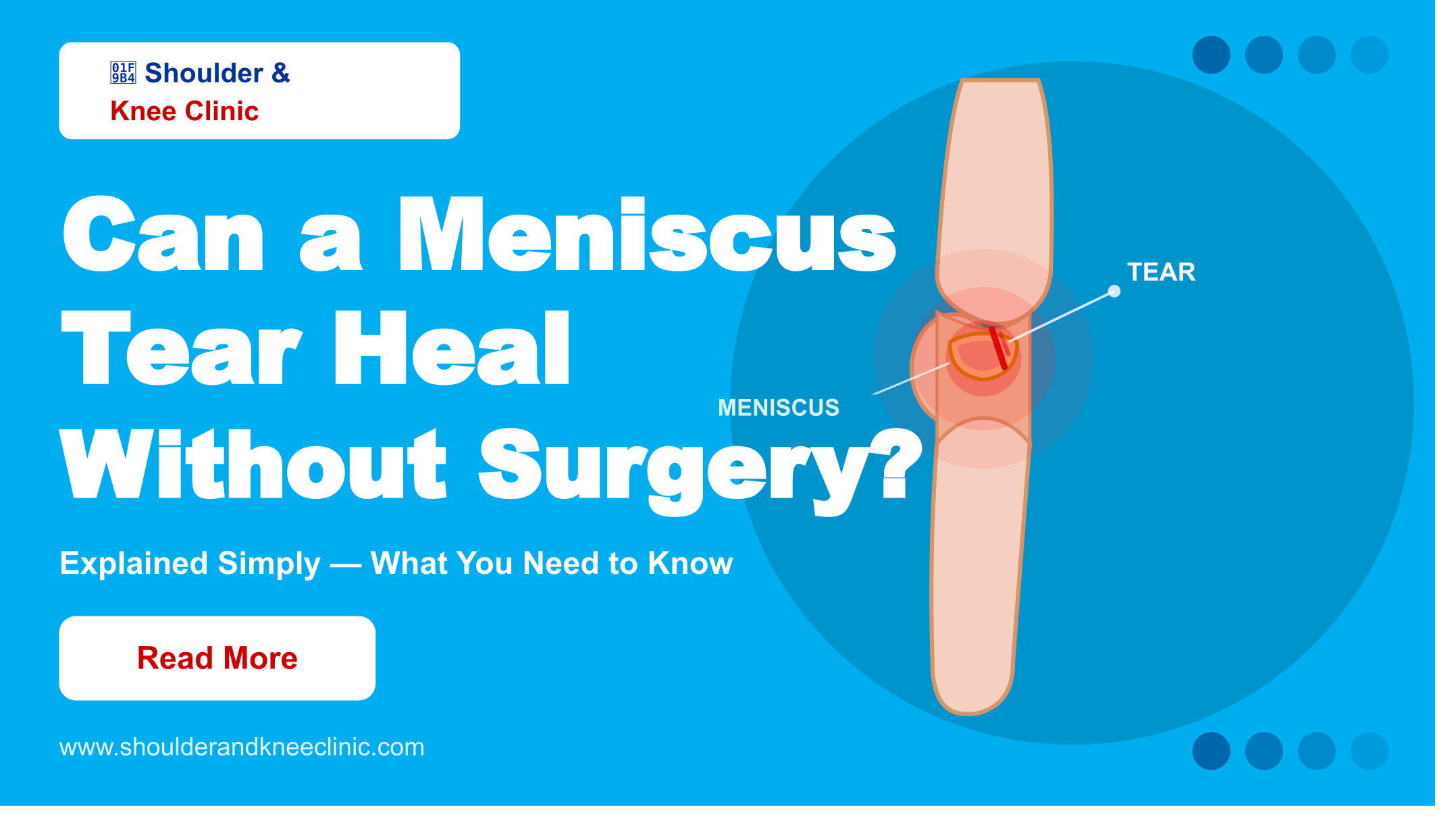 Can a Meniscus Tear Heal Without Surgery? Explained Simply
